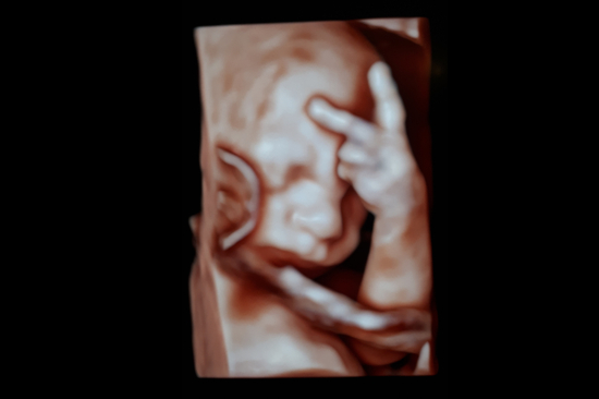 Screening Obstetrical ultrasound