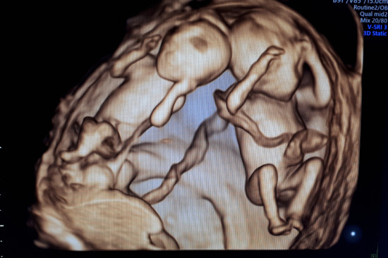 Level 3 obstetrical ultrasound